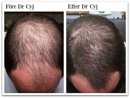 Peptide hair loss therapy – DR. CYJ Hair Filler – Aesthetic Medicine – dr  Marcin Nowak