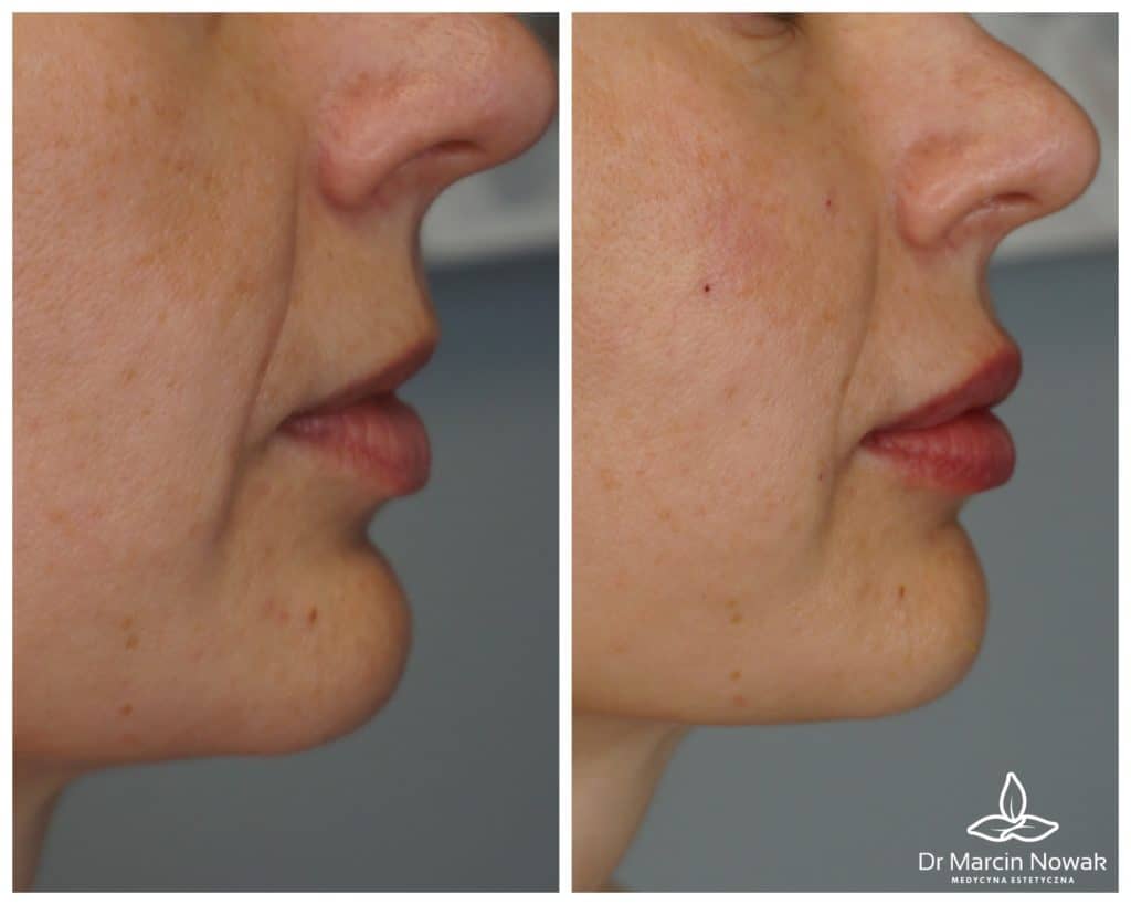 Metamorfoza Lipotransfer (Przeszczep tłuszczu)