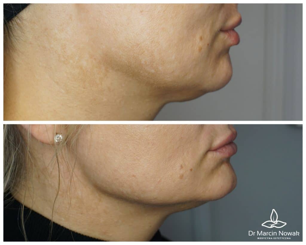 Metamorfoza Modelowanie linii żuchwy