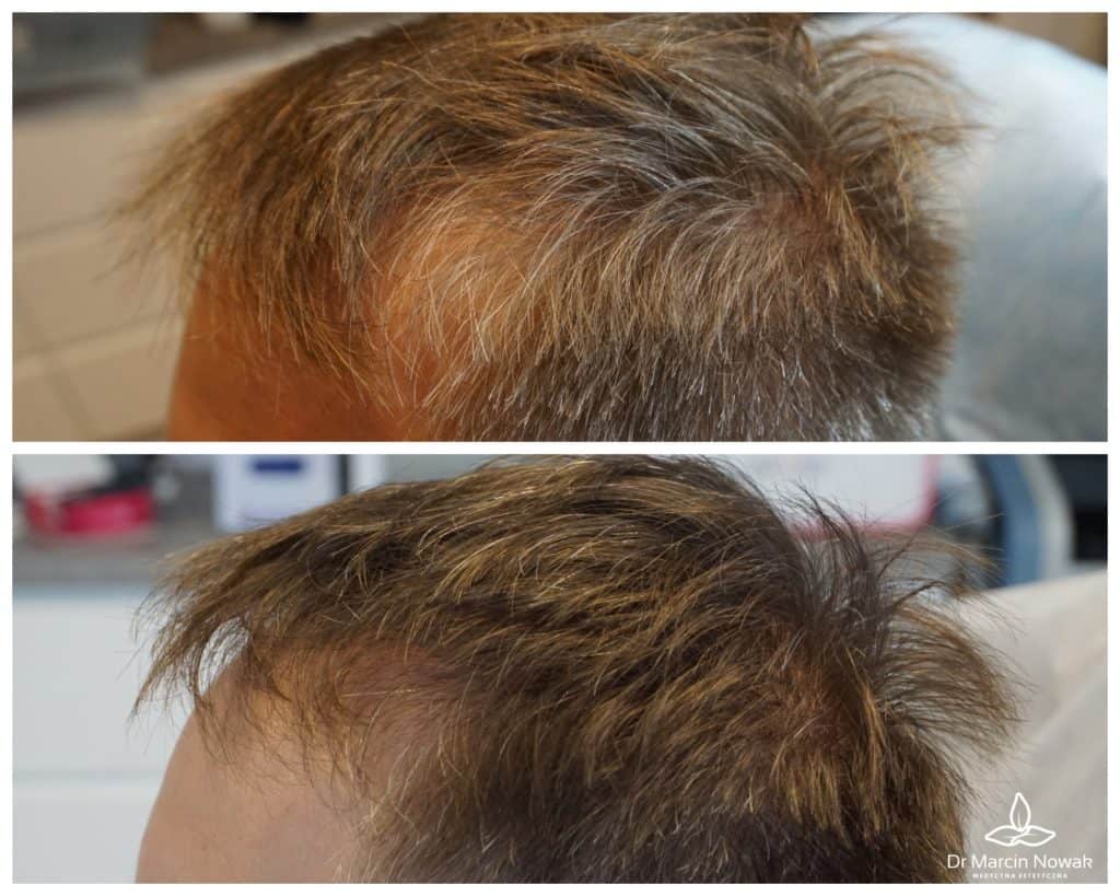 Metamorfoza Regenera Activa