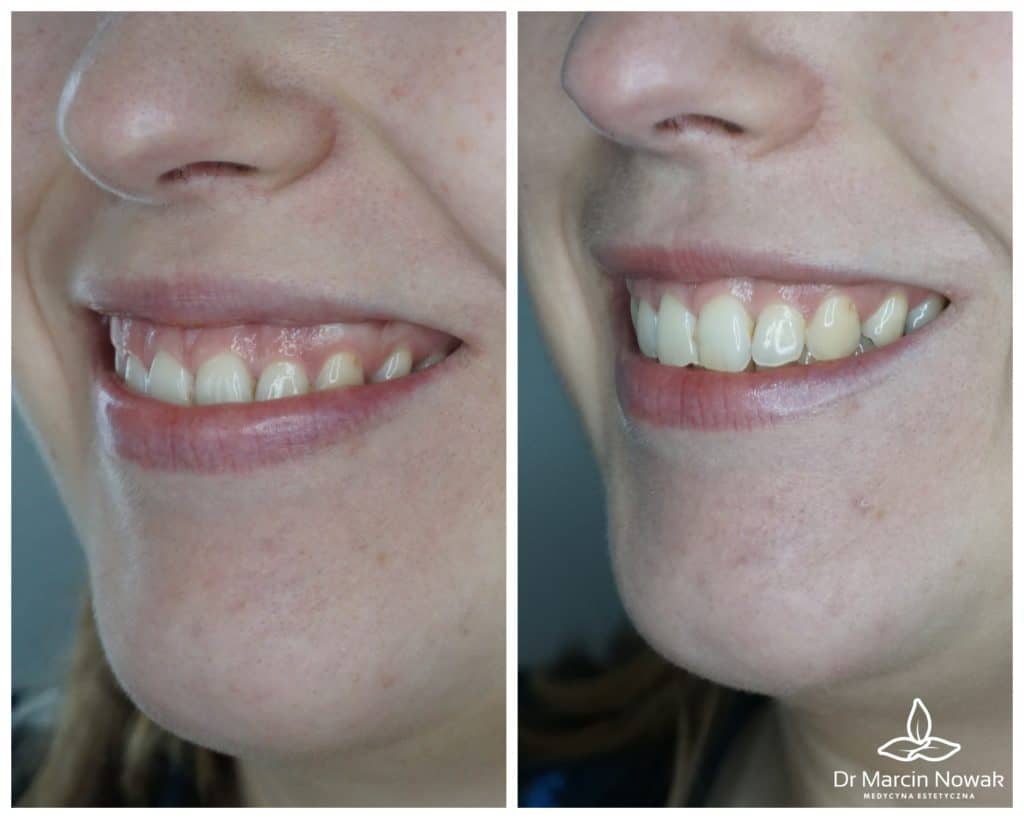 Metamorfoza Uśmiech dziąsłowy (Gummy Smile)