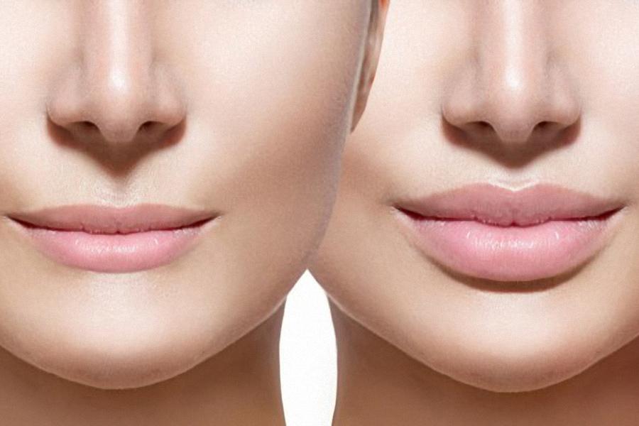 Powiększanie i modelowanie ust: Jak uzyskać naturalny efekt bez przerysowania?