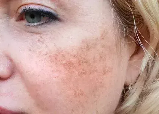 [UK] Melasma