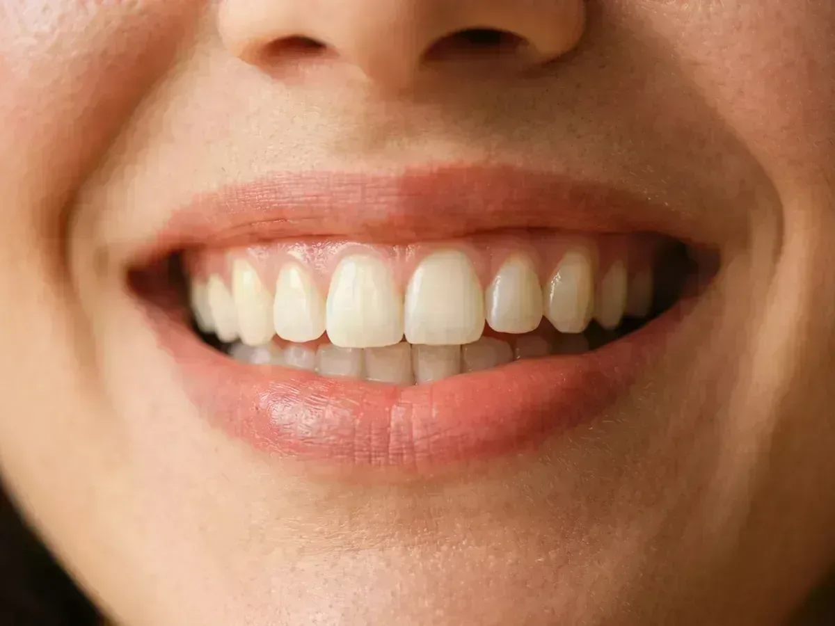 Uśmiech dziąsłowy (Gummy Smile)