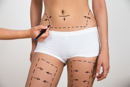 39679308 - person hand drawing lines on woman's abdomen and leg for abdominal cellulite correction