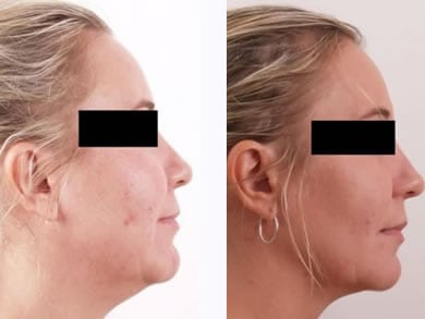 exilis_chin_before_after-thmbnl
