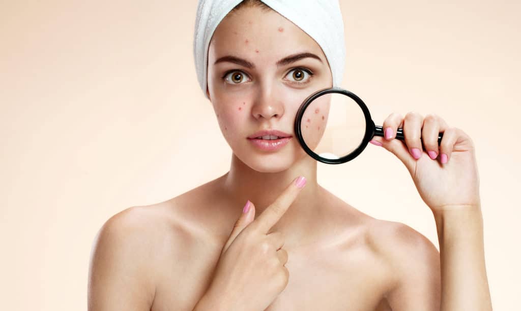 Teen girl with problem skin look at pimple with magnifying glass. Woman skin care concept